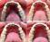 Aparelho ortodôntico alinha os dentes sem prejudicar a estética 